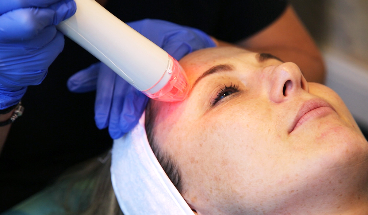 We try: Vivace laser facial treatment