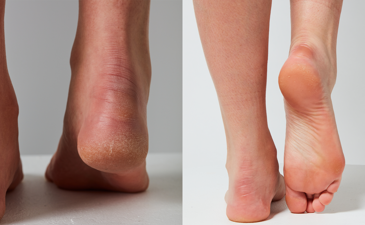 cracked heels before and after